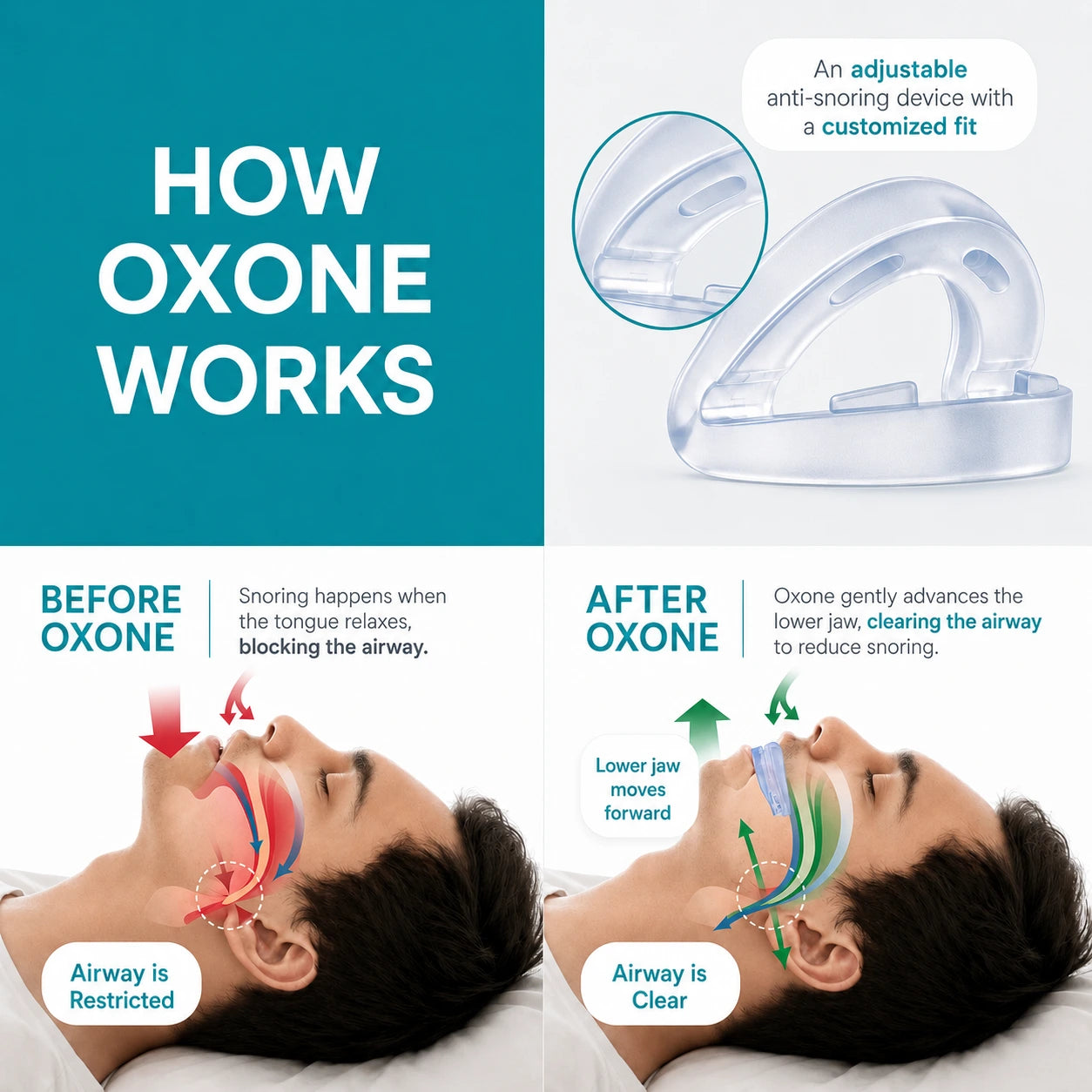 Anti-Snoring Mouthpiece Device